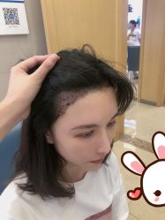 点击看大图 -大麦微针植发丨全国连锁