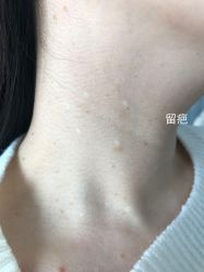 -爱莎扁平疣·汗管瘤·斑痣中心