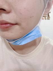 体验前-痣清宫祛斑祛痣连锁店