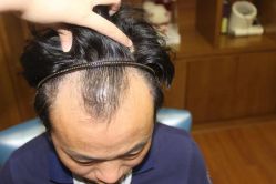 -大麦微针植发全国连锁