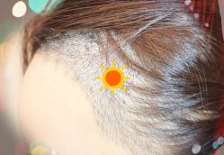 -大麦微针植发全国连锁