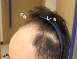 -大麦微针植发全国连锁