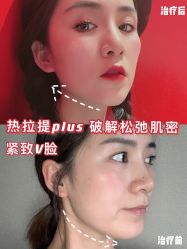 -蚌埠国色医疗美容医院•眼鼻整形