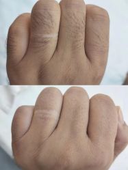 -薇兰专业脱毛连锁机构