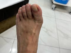 -Andrew指甲专科灰指甲·甲沟炎矫正·3D步态矫形鞋垫定制(浦三路店)