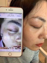 -美丽人生祛斑扁平疣汗管瘤中心