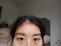 体验后-大麦微针植发丨全国连锁
