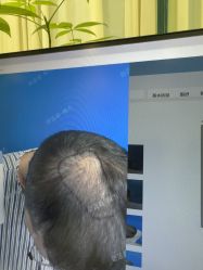 -碧莲盛·不剃发植发