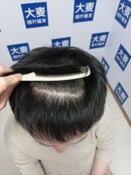 -大麦微针植发丨全国连锁