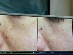 体验前-苑苑vbeauty科技美容SPA