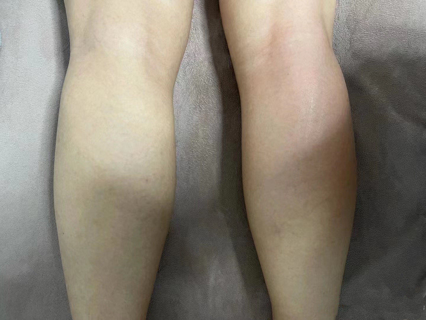 小腿减脂,塑形小腿减脂即刻效果对比做完右