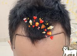 -大麦微针植发全国连锁