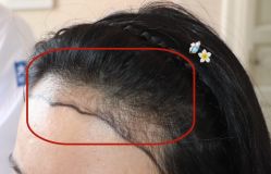 -大麦微针植发全国连锁