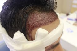 -大麦微针植发丨全国连锁