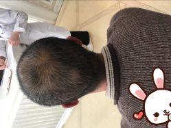 点击看大图 -大麦微针植发丨全国连锁