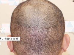 -大麦微针植发全国连锁