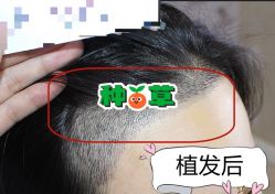 -大麦微针植发全国连锁