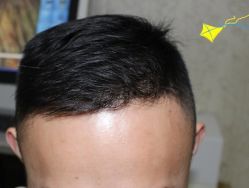 -大麦微针植发丨全国连锁