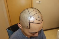 -大麦微针植发丨全国连锁