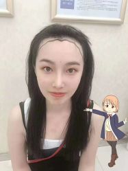 -大麦微针植发丨全国连锁