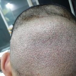 体验前-碧莲盛·不剃发植发