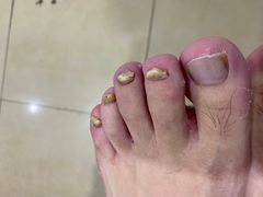-世龙世家灰指甲·甲沟炎·跖疣护理·修脚(东江湾路店)