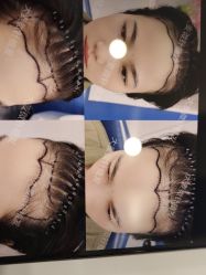 体验前-大麦微针植发全国连锁