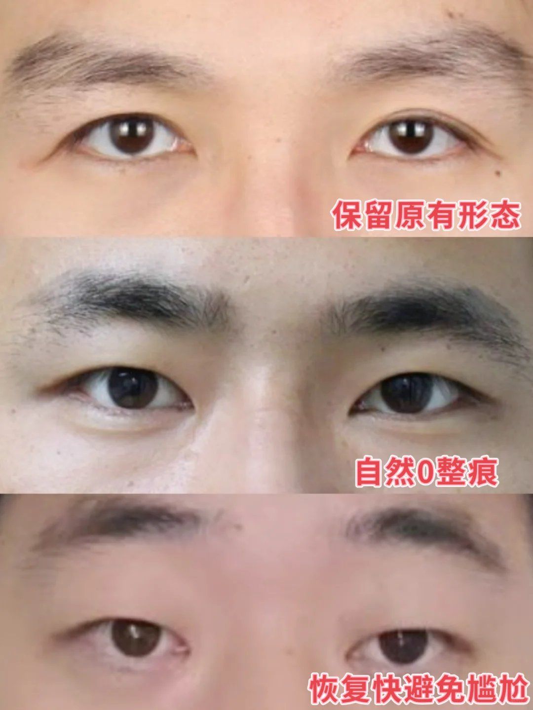 男生眼睛变大有神,不切双眼皮也可以做到!