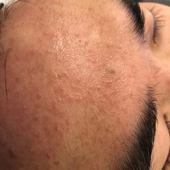 -瓷肌博士·祛痘科技美肤