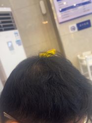 -碧莲盛·不剃发植发