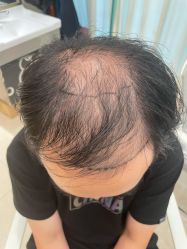 点击看大图 -碧莲盛·不剃发植发