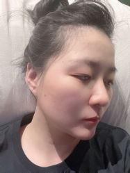 体验后-北京英煌医疗美容