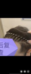 -大麦微针植发全国连锁