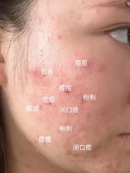 -成都苗方清颜专业祛痘