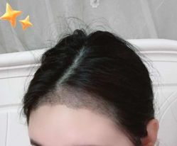 -大麦微针植发丨全国连锁