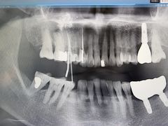 -上海仁爱医院口腔科 · 种植