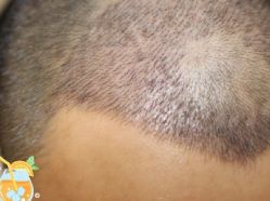 -大麦微针植发丨全国连锁