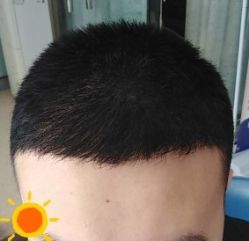 -大麦微针植发丨全国连锁