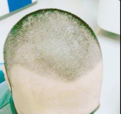 -大麦微针植发丨全国连锁