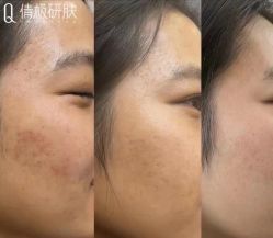 -倩极·精研痘敏肌管理