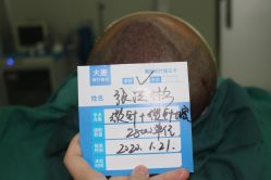 -大麦微针植发全国连锁