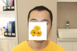 -大麦微针植发丨全国连锁