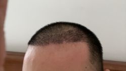 -大麦微针植发丨全国连锁