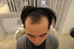 -大麦微针植发丨全国连锁