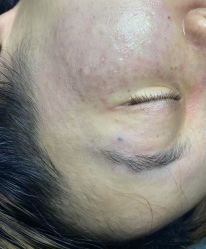 体验后-爱莎扁平疣·汗管瘤·斑痣中心