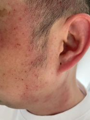 -爱莎扁平疣·汗管瘤·斑痣中心