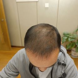 -大麦微针植发全国连锁