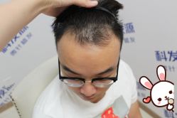 -大麦微针植发丨全国连锁