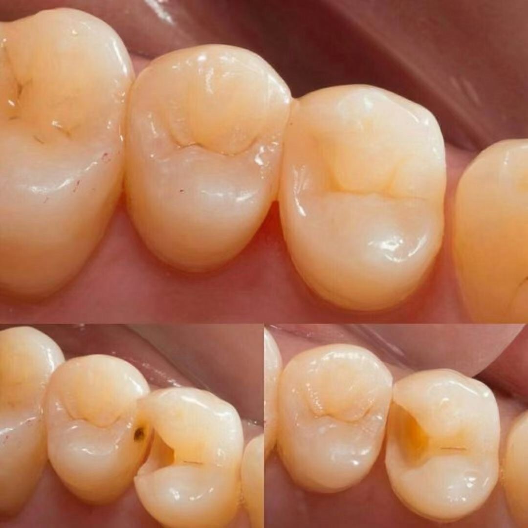 临面龋齿补牙前后对比