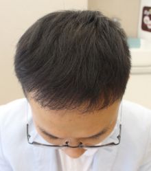 -大麦微针植发全国连锁